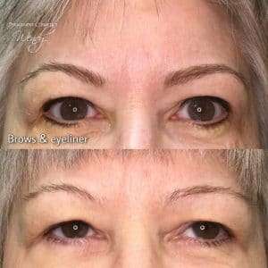 eyebrow before and after treatment