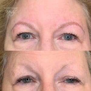 brows after healing