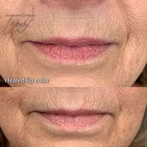 post treatment lips before after