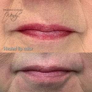 before and after lip enhancement