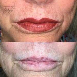 lip enhancement