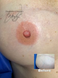 areola reconstruction near you in Columbus GA